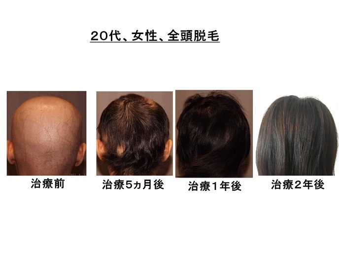 円形脱毛症　病院